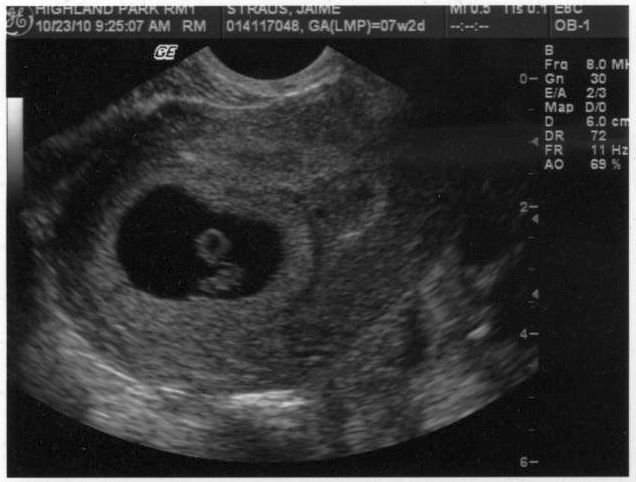Как выглядит эмбрион на 7 неделе беременности фото узи